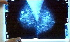 Breast tumour