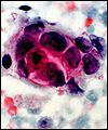 Breast cancer cells
