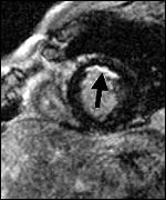 MRI scan