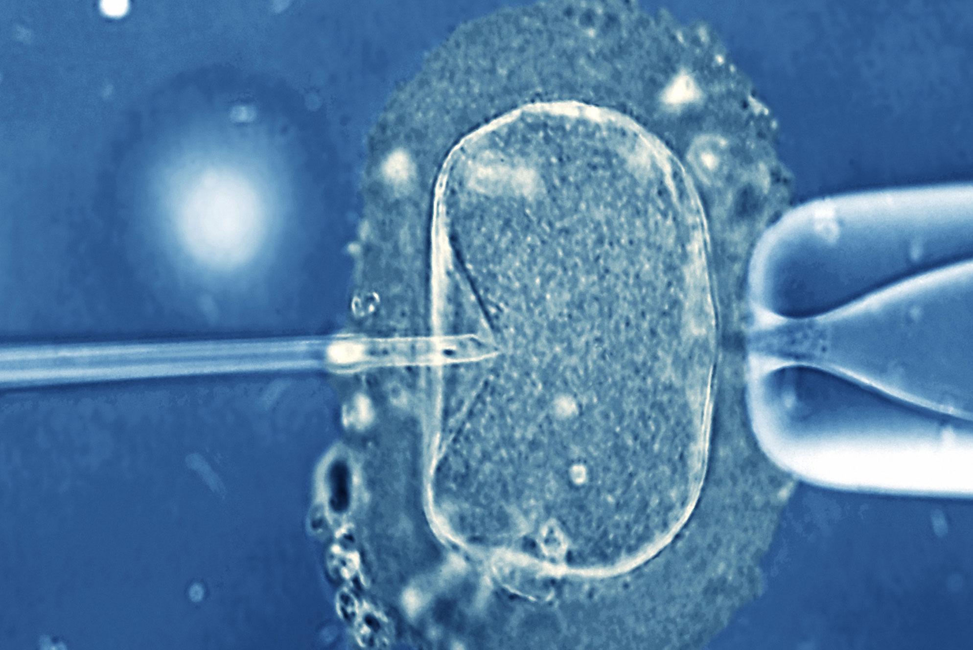 IVF procedure