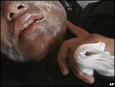 زخمی ہونے والی ایک لڑکی