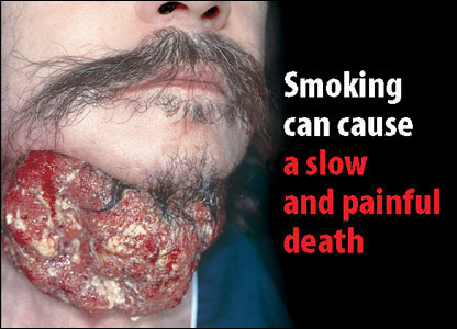 smoking_tumour.jpg