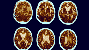 Alzheimer's Disease