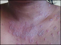 skin damage