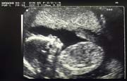 Ultrasound image of a foetus