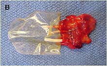 kidney B