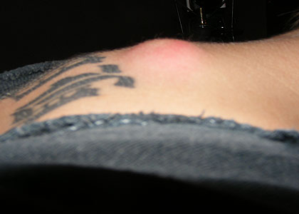 080417_stu_cyst_300.jpg
