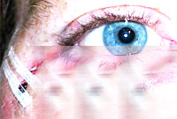 bruised eye