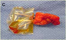 kidney C