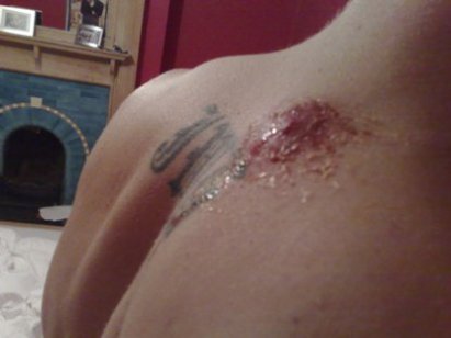 cyst1.jpg