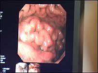 Unhealthy liver