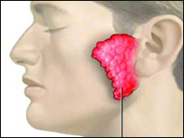 کله چرک