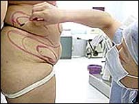Liposukce