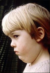 گوشک (Mumps)