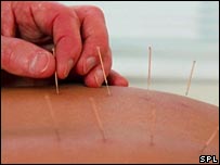 acupuntura