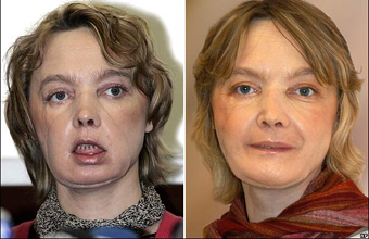 Isabelle Dinoire