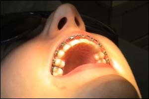 College with braces